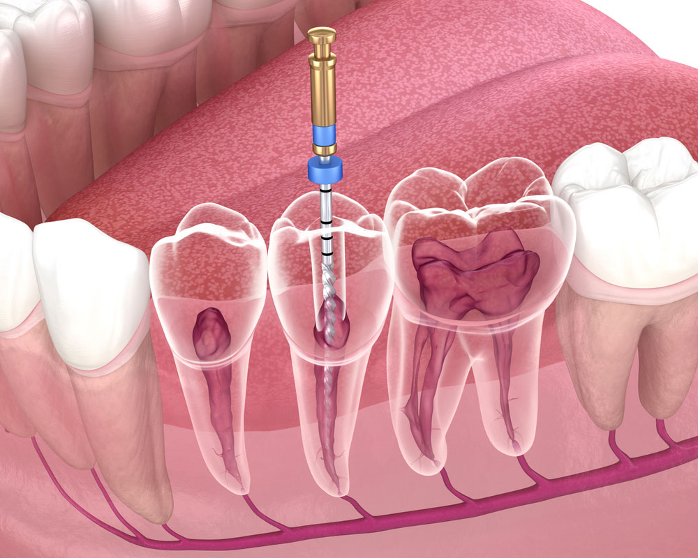 Specialist in Root Canal