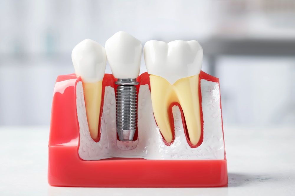 Tooth Implant
